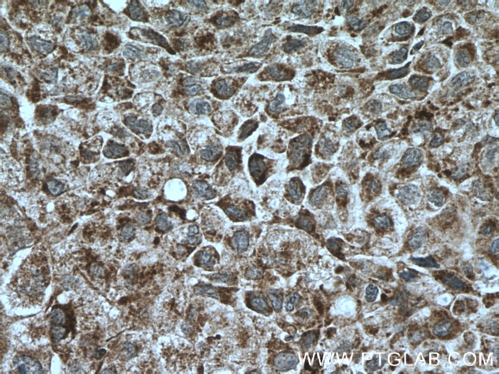 Immunohistochemistry (IHC) staining of human lung cancer tissue using UBAP1 Polyclonal antibody (12385-1-AP)