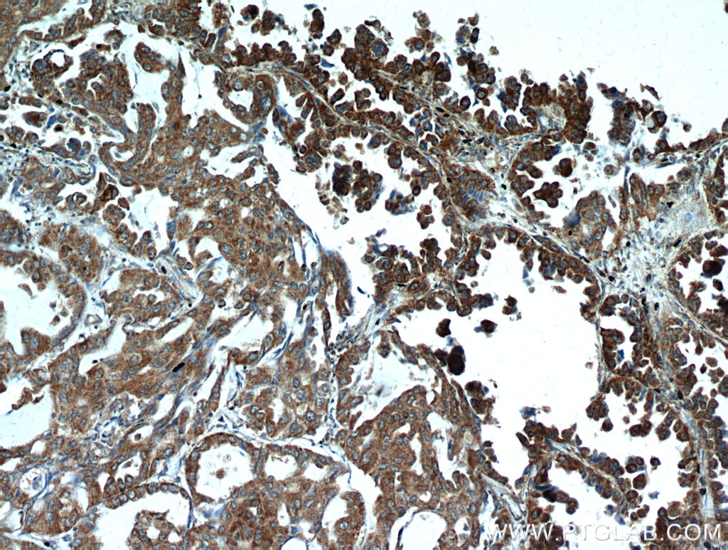 Immunohistochemistry (IHC) staining of human lung cancer tissue using UBAP1 Polyclonal antibody (12385-1-AP)