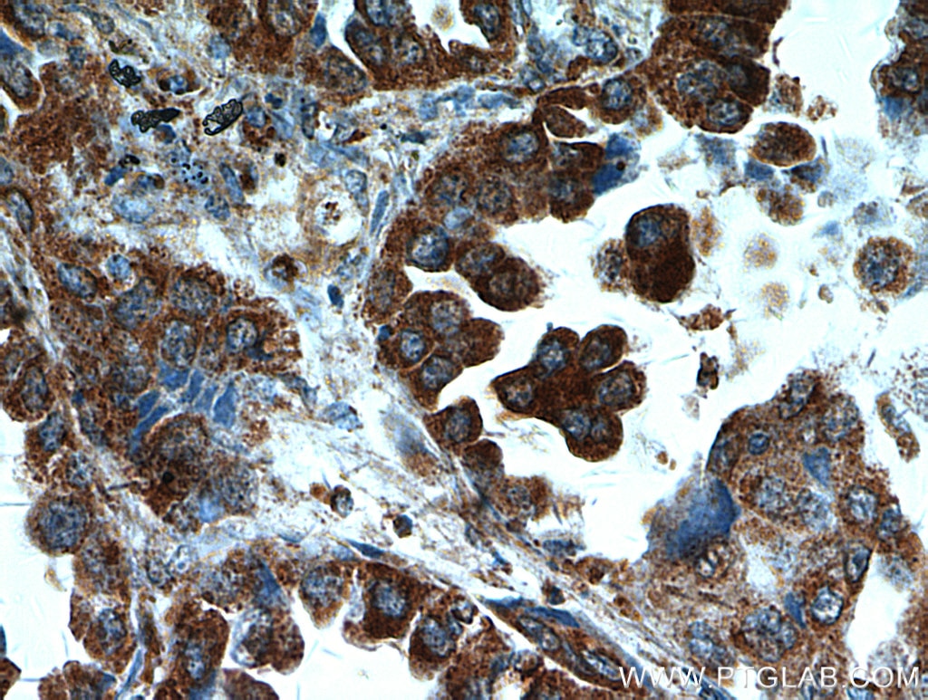 Immunohistochemistry (IHC) staining of human lung cancer tissue using UBAP1 Polyclonal antibody (12385-1-AP)