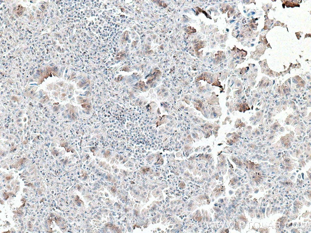 Immunohistochemistry (IHC) staining of human lung cancer tissue using UBAP1 Monoclonal antibody (66993-1-Ig)