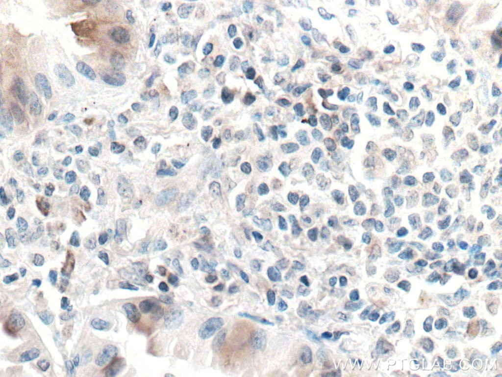 Immunohistochemistry (IHC) staining of human lung cancer tissue using UBAP1 Monoclonal antibody (66993-1-Ig)