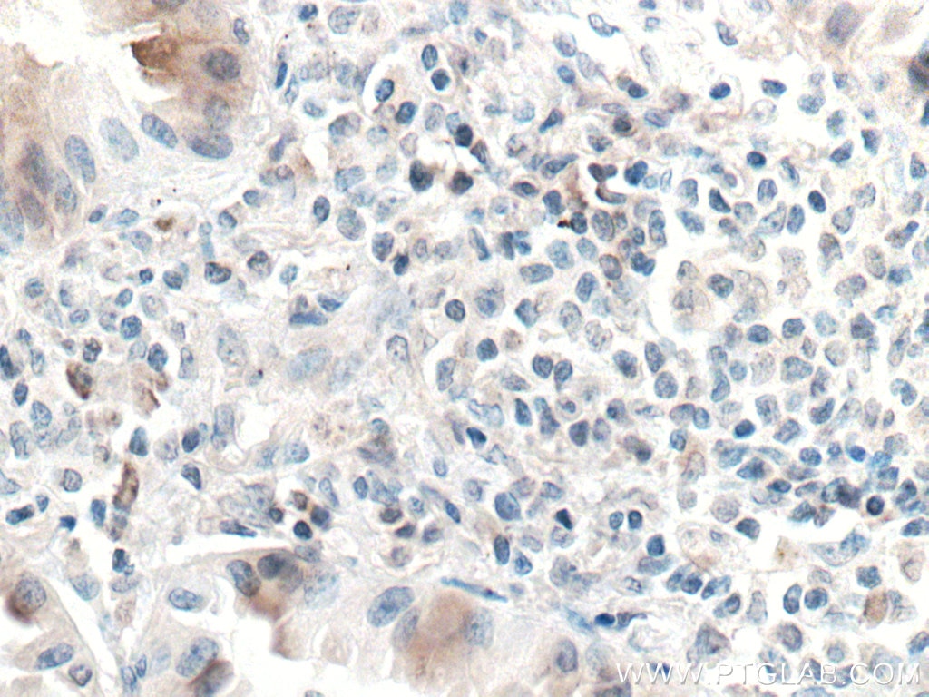Immunohistochemistry (IHC) staining of human lung cancer tissue using UBAP1 Monoclonal antibody (66993-1-Ig)