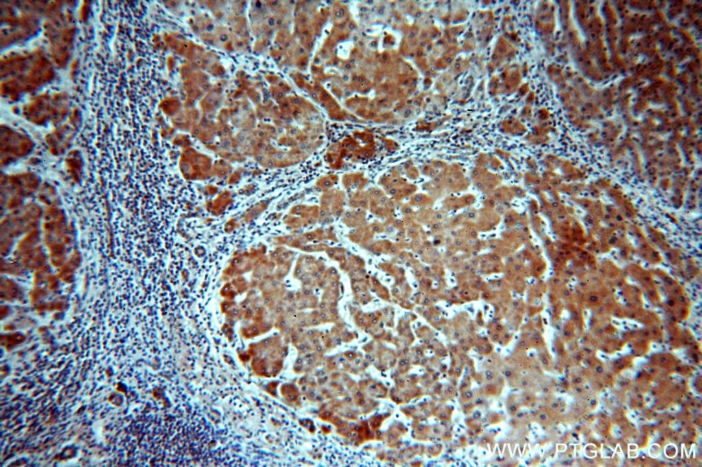 Immunohistochemistry (IHC) staining of human hepatocirrhosis tissue using UBASH3B/STS 1 Polyclonal antibody (19563-1-AP)