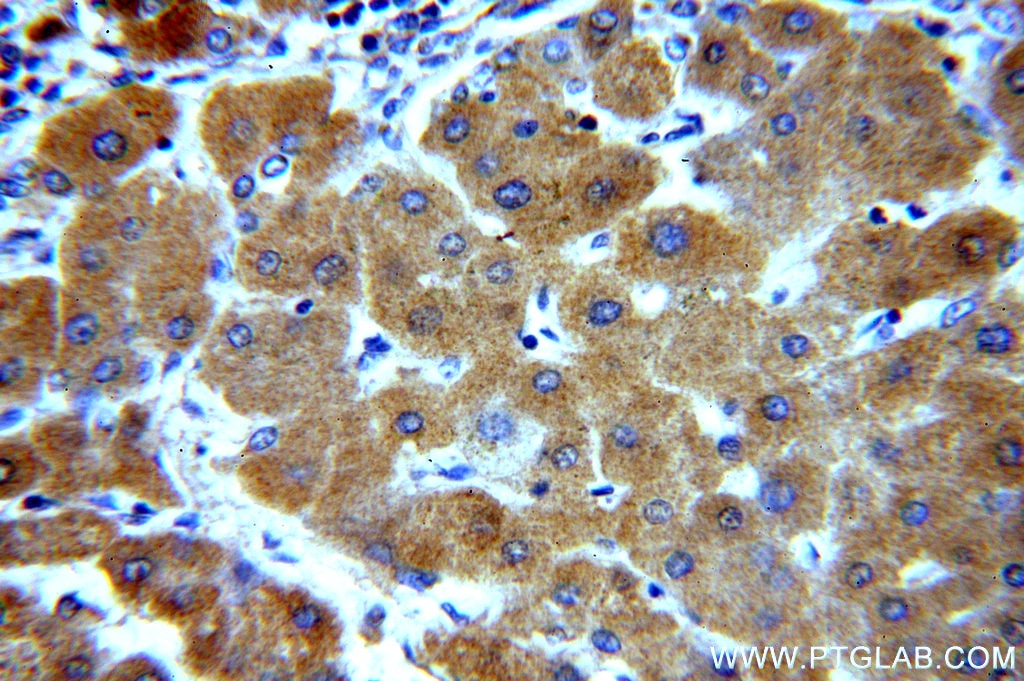 Immunohistochemistry (IHC) staining of human hepatocirrhosis tissue using UBASH3B/STS 1 Polyclonal antibody (19563-1-AP)