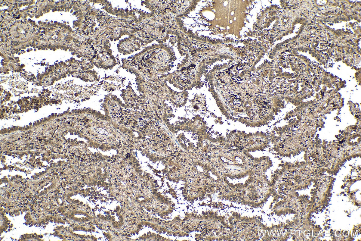 Immunohistochemistry (IHC) staining of human lung cancer tissue using UBC Polyclonal antibody (10457-1-AP)