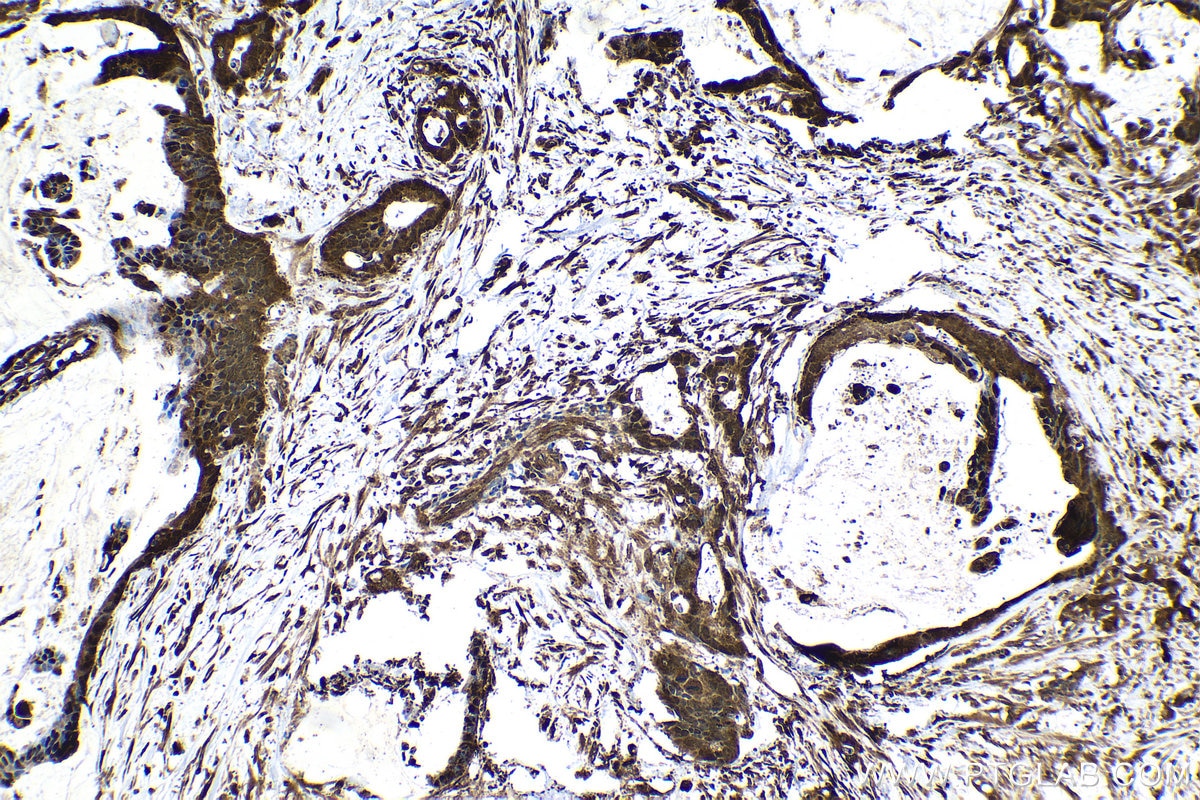 Immunohistochemistry (IHC) staining of human urothelial carcinoma tissue using UBC Polyclonal antibody (10457-1-AP)