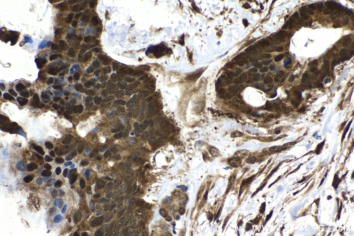 Immunohistochemistry (IHC) staining of human urothelial carcinoma tissue using UBC Polyclonal antibody (10457-1-AP)