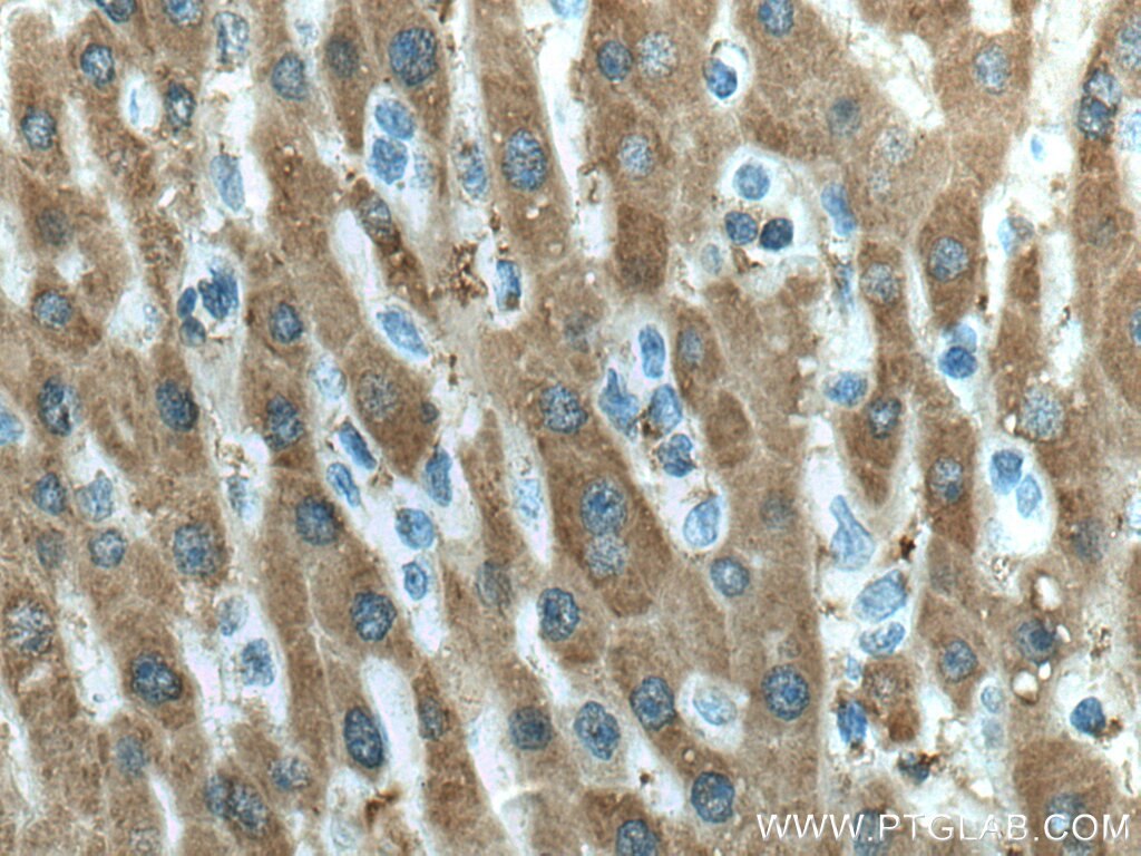 Immunohistochemistry (IHC) staining of human liver cancer tissue using UBC12 Monoclonal antibody (67482-1-Ig)