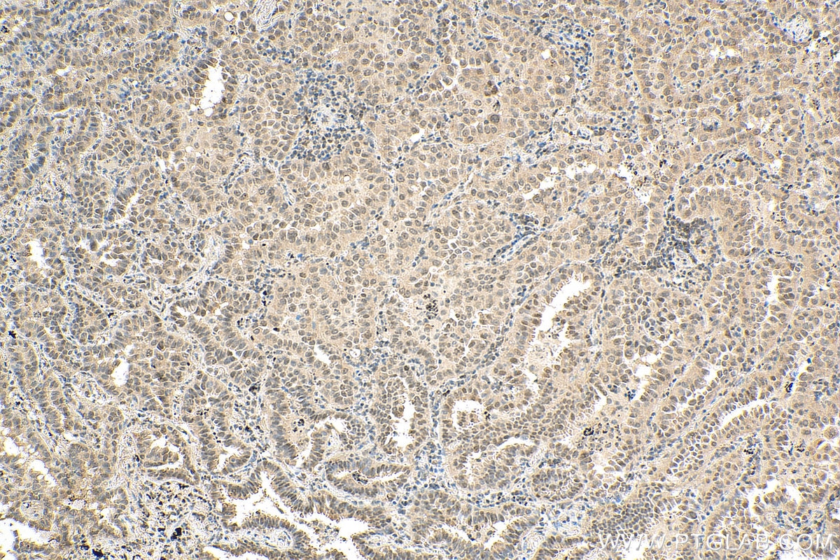 Immunohistochemistry (IHC) staining of human lung cancer tissue using UBC9 Polyclonal antibody (10070-1-AP)