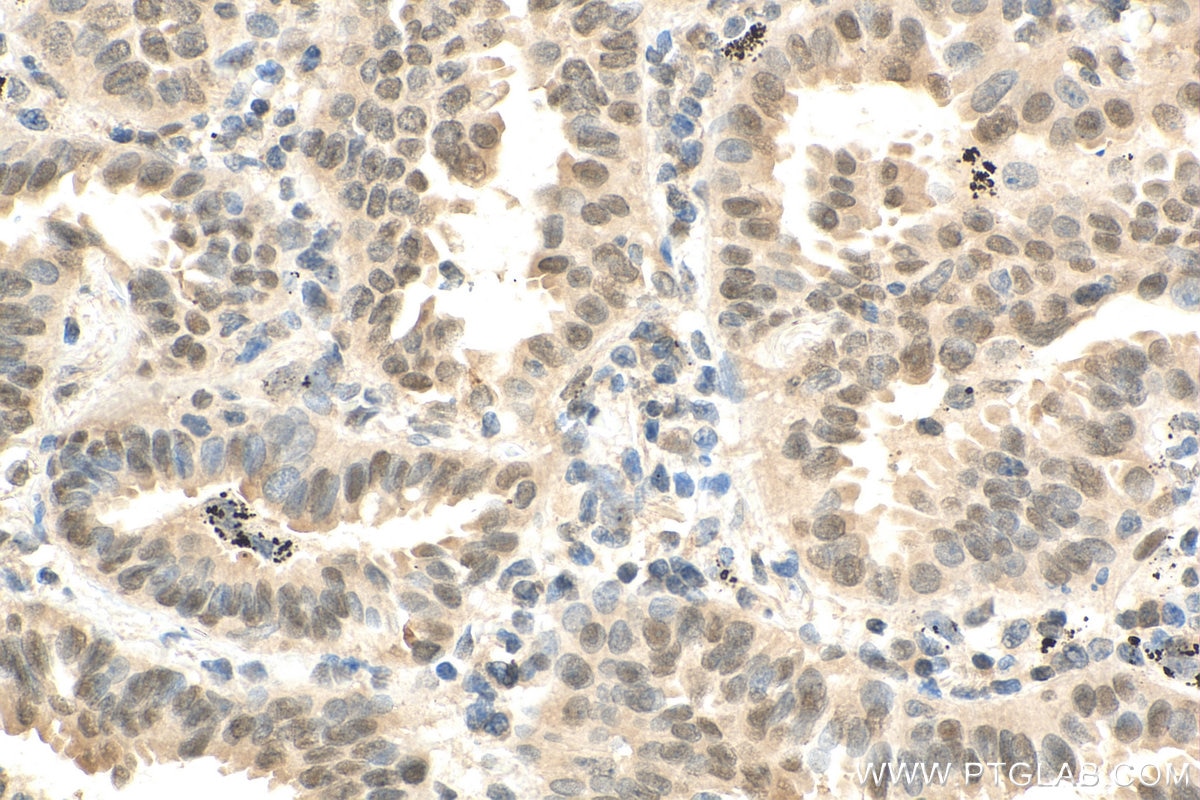 Immunohistochemistry (IHC) staining of human lung cancer tissue using UBC9 Polyclonal antibody (10070-1-AP)