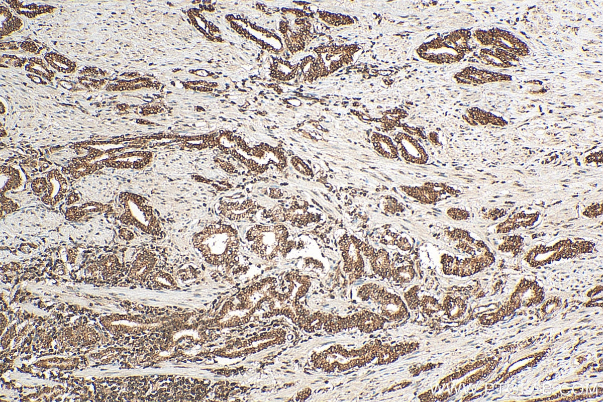 Immunohistochemistry (IHC) staining of human prostate cancer tissue using UBC9 Polyclonal antibody (10070-1-AP)