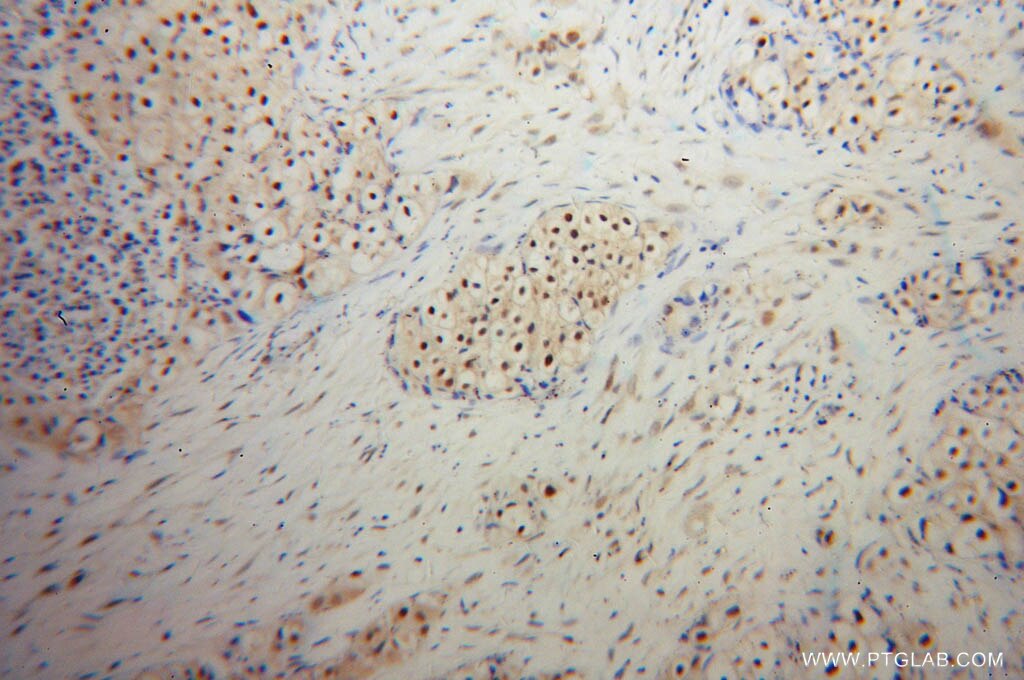 Immunohistochemistry (IHC) staining of human lung cancer tissue using UBC9 Polyclonal antibody (10224-1-AP)