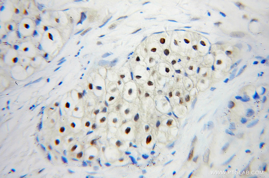 Immunohistochemistry (IHC) staining of human lung cancer tissue using UBC9 Polyclonal antibody (10224-1-AP)