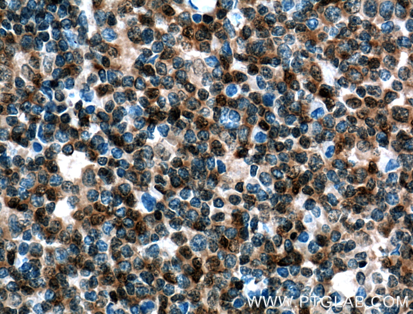 Immunohistochemistry (IHC) staining of human lymphoma tissue using UBC9 Monoclonal antibody (60201-1-Ig)