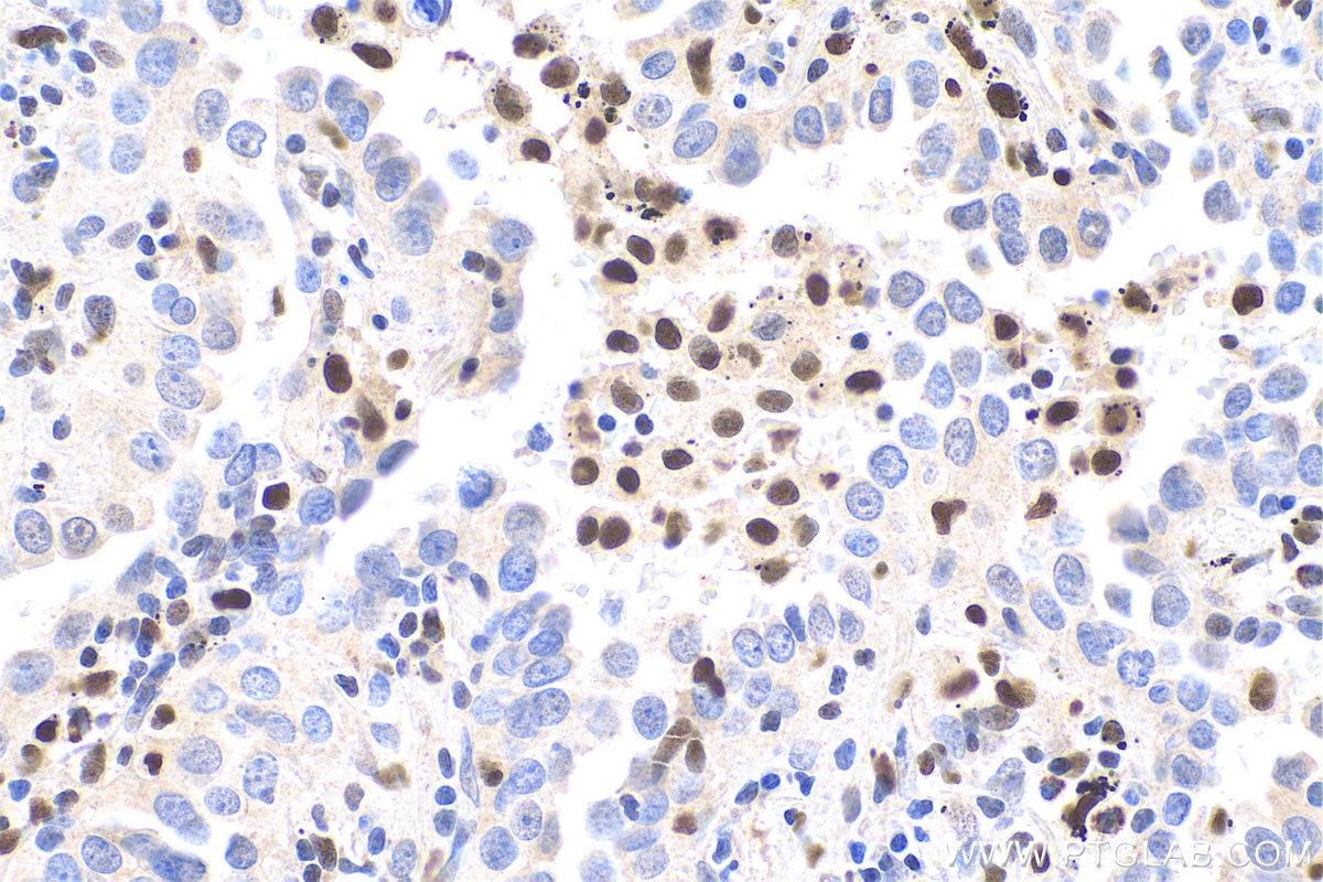 Immunohistochemistry (IHC) staining of human lung cancer tissue using FAT10 Polyclonal antibody (13003-2-AP)