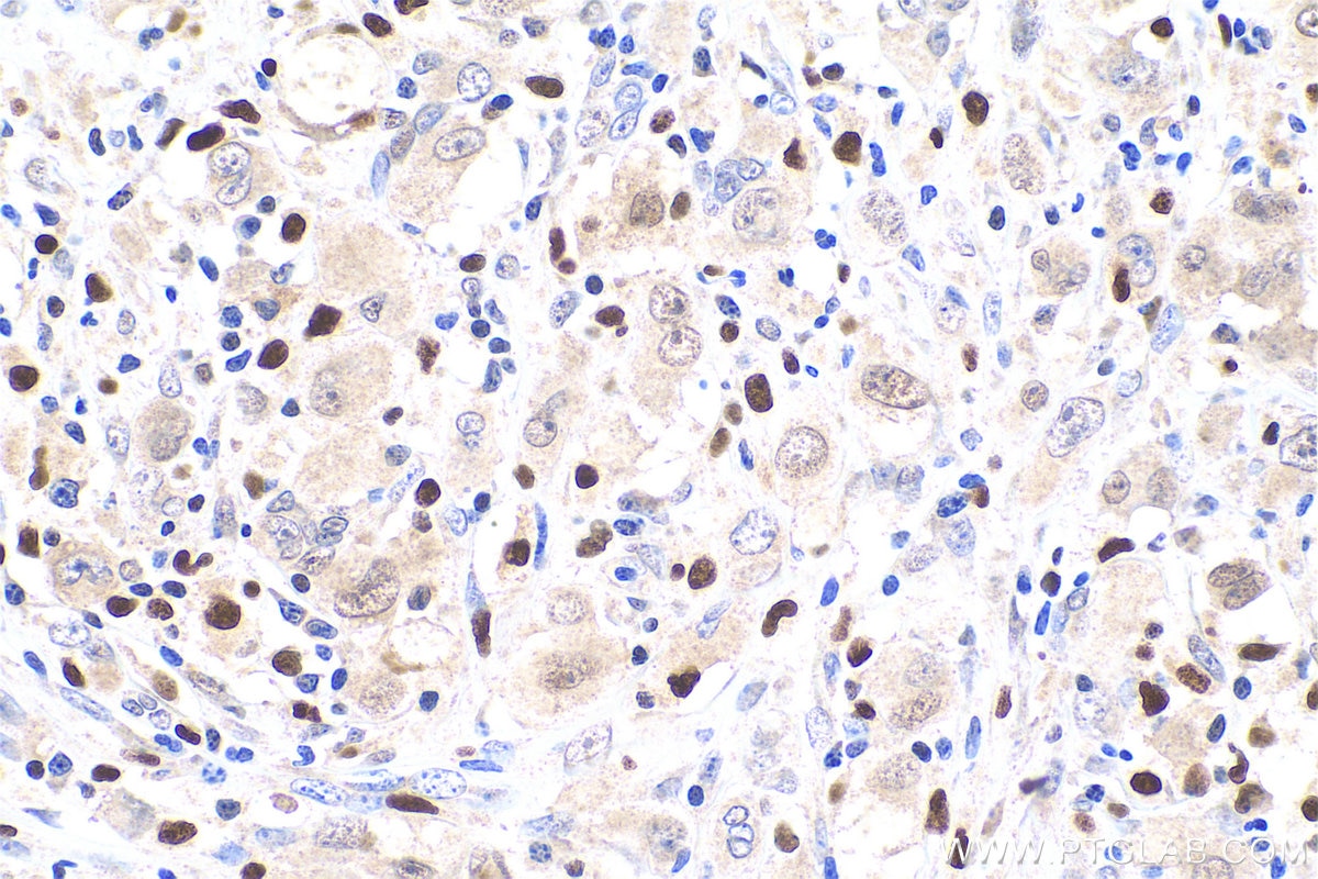 Immunohistochemistry (IHC) staining of human lymphoma tissue using FAT10 Polyclonal antibody (13003-2-AP)