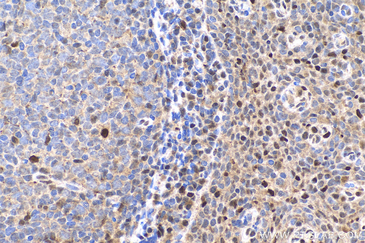 Immunohistochemistry (IHC) staining of human tonsillitis tissue using FAT10 Polyclonal antibody (13003-2-AP)