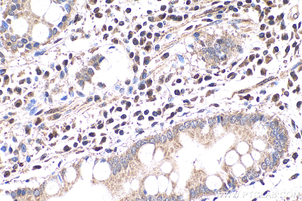 Immunohistochemistry (IHC) staining of human stomach cancer tissue using FAT10 Polyclonal antibody (13003-2-AP)