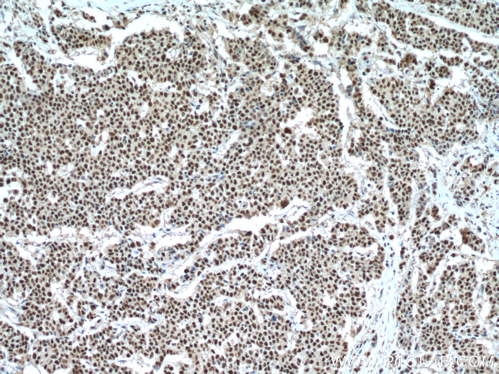 Immunohistochemistry (IHC) staining of human colon cancer tissue using UBE1 Polyclonal antibody (15912-1-AP)