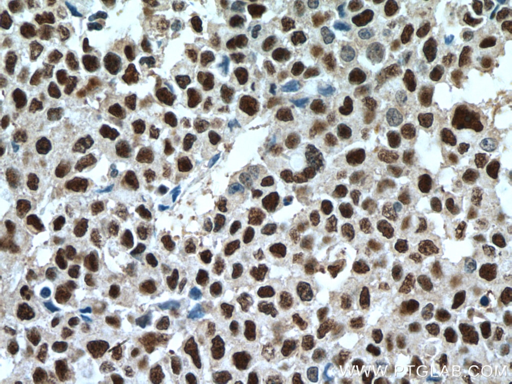 IHC staining of human colon cancer using 15912-1-AP