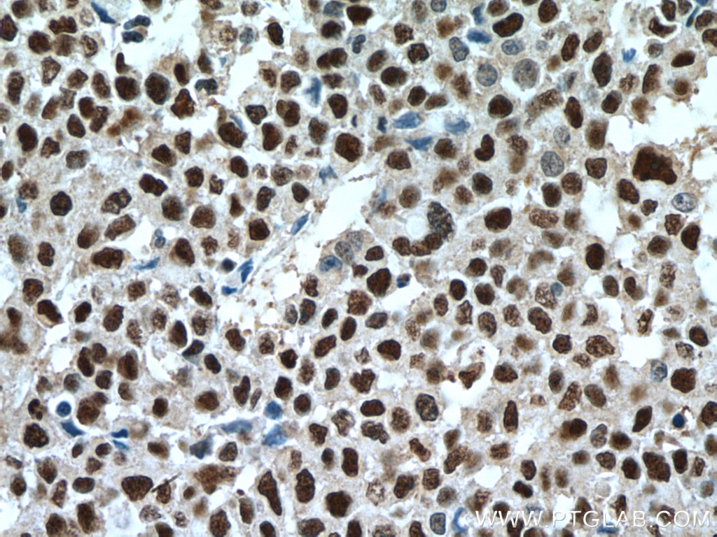 Immunohistochemistry (IHC) staining of human colon cancer tissue using UBE1 Polyclonal antibody (15912-1-AP)