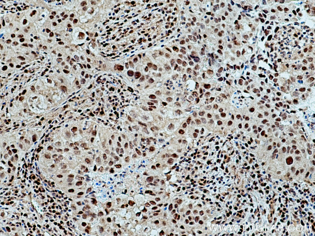 Immunohistochemistry (IHC) staining of human lung cancer tissue using UBE1 Monoclonal antibody (67198-1-Ig)
