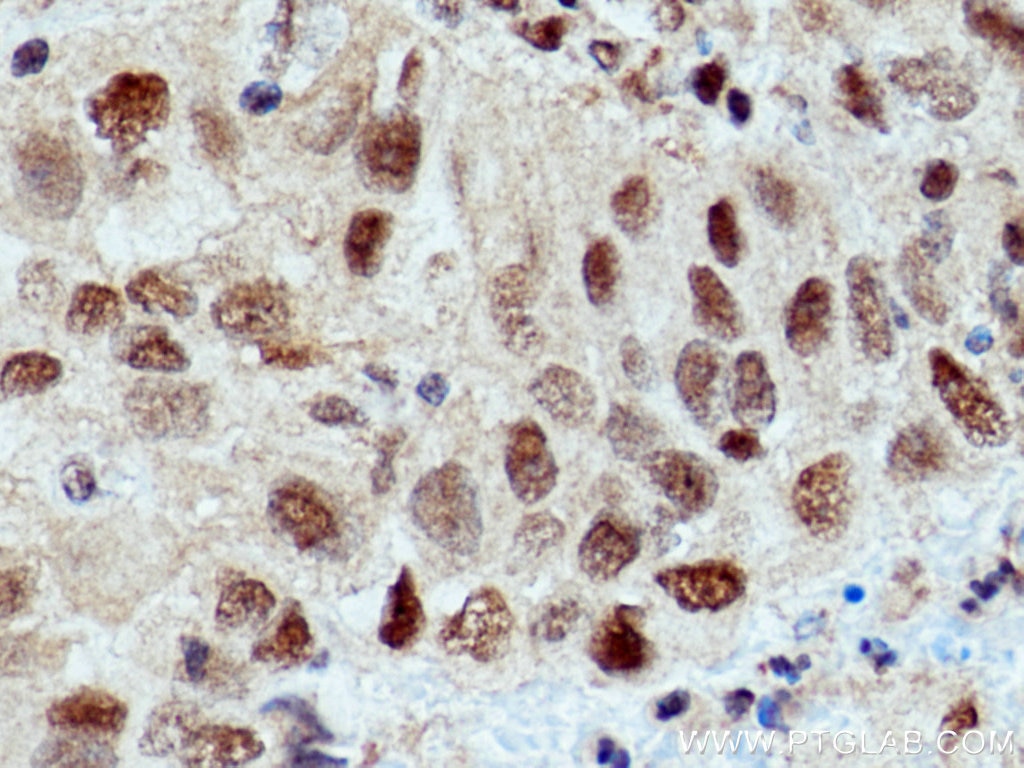 Immunohistochemistry (IHC) staining of human lung cancer tissue using UBE1 Monoclonal antibody (67198-1-Ig)