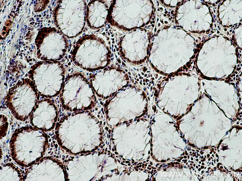 Immunohistochemistry (IHC) staining of human colon cancer tissue using UBE1 Monoclonal antibody (67198-1-Ig)