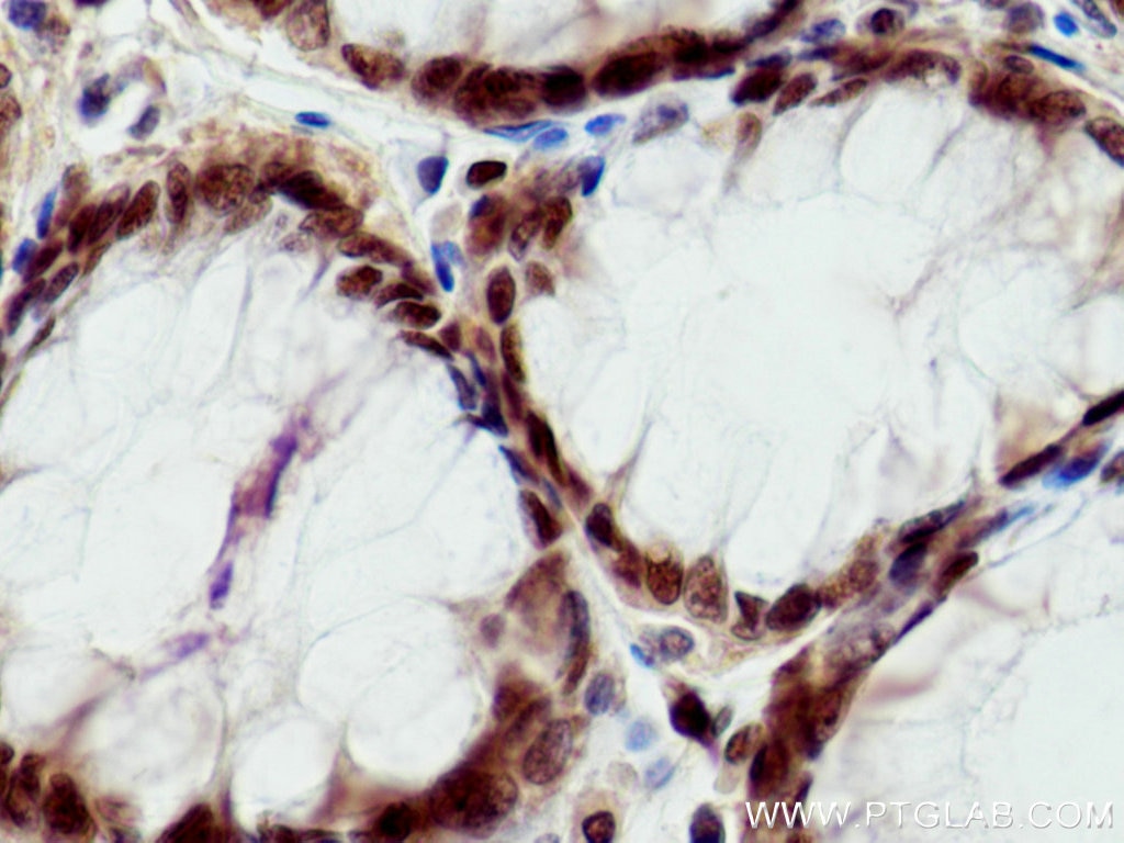 Immunohistochemistry (IHC) staining of human colon cancer tissue using UBE1 Monoclonal antibody (67198-1-Ig)