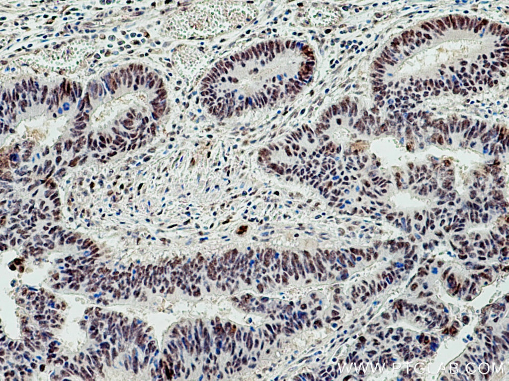 Immunohistochemistry (IHC) staining of human colon cancer tissue using UBE1 Monoclonal antibody (67198-1-Ig)