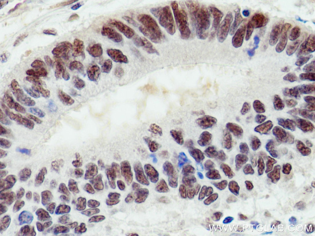 Immunohistochemistry (IHC) staining of human colon cancer tissue using UBE1 Monoclonal antibody (67198-1-Ig)