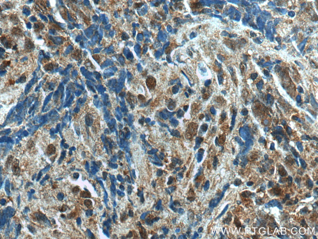 Immunohistochemistry (IHC) staining of human nasopharyngeal carcinoma tissue using UBE2A Polyclonal antibody (11080-1-AP)