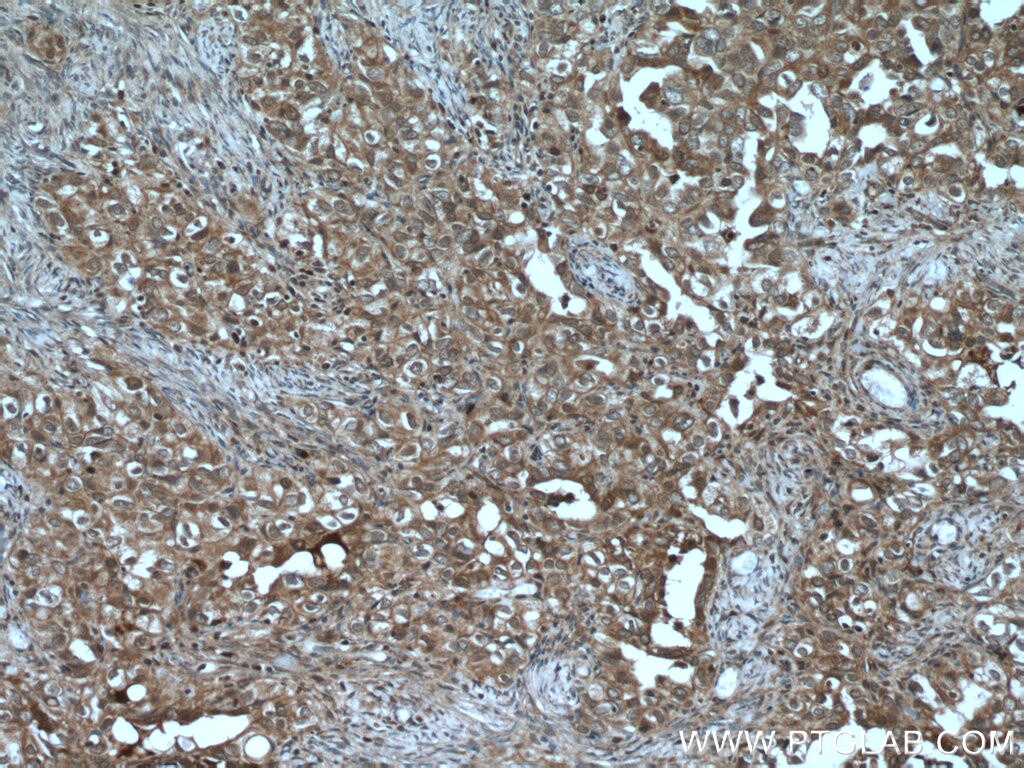 Immunohistochemistry (IHC) staining of human ovary tumor tissue using UBE2B Polyclonal antibody (10733-1-AP)