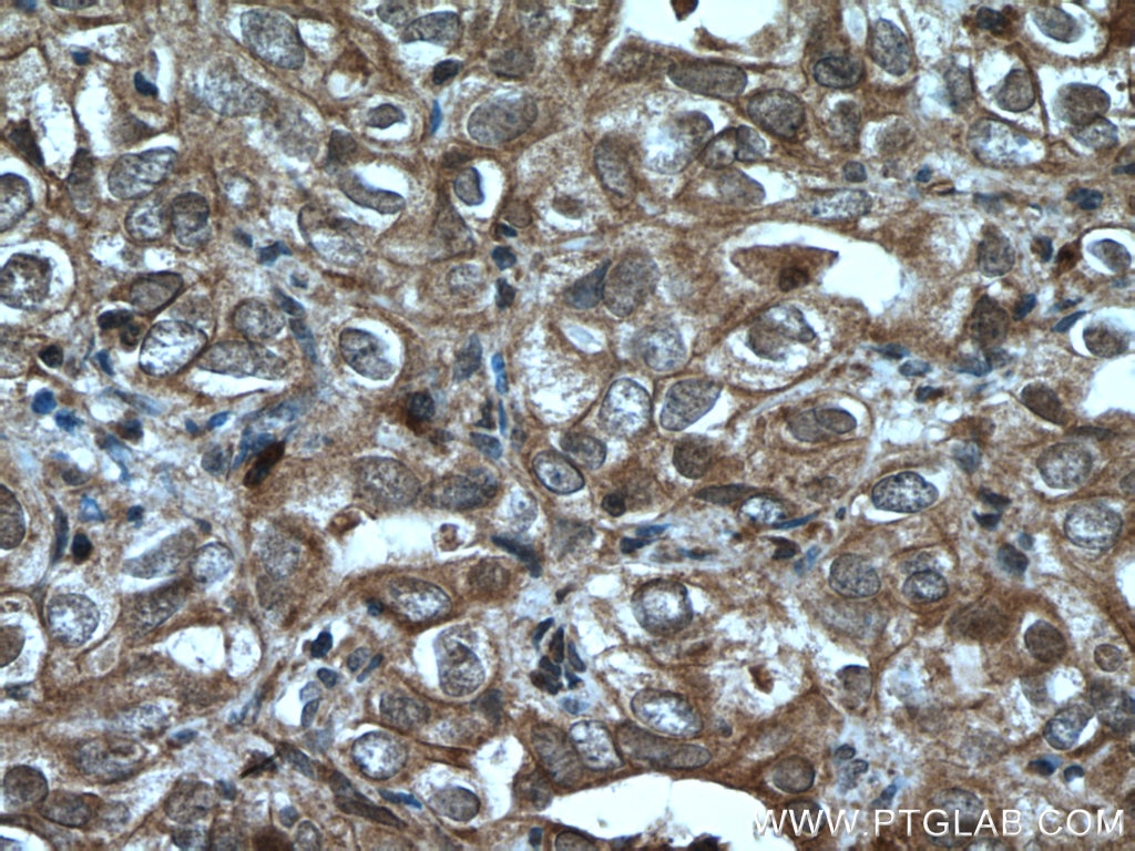 Immunohistochemistry (IHC) staining of human ovary tumor tissue using UBE2B Polyclonal antibody (10733-1-AP)