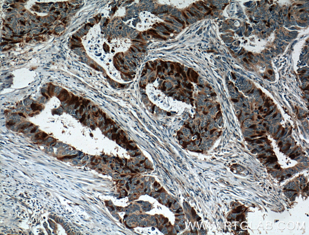 Immunohistochemistry (IHC) staining of human colon cancer tissue using UBE2C Polyclonal antibody (12134-2-AP)