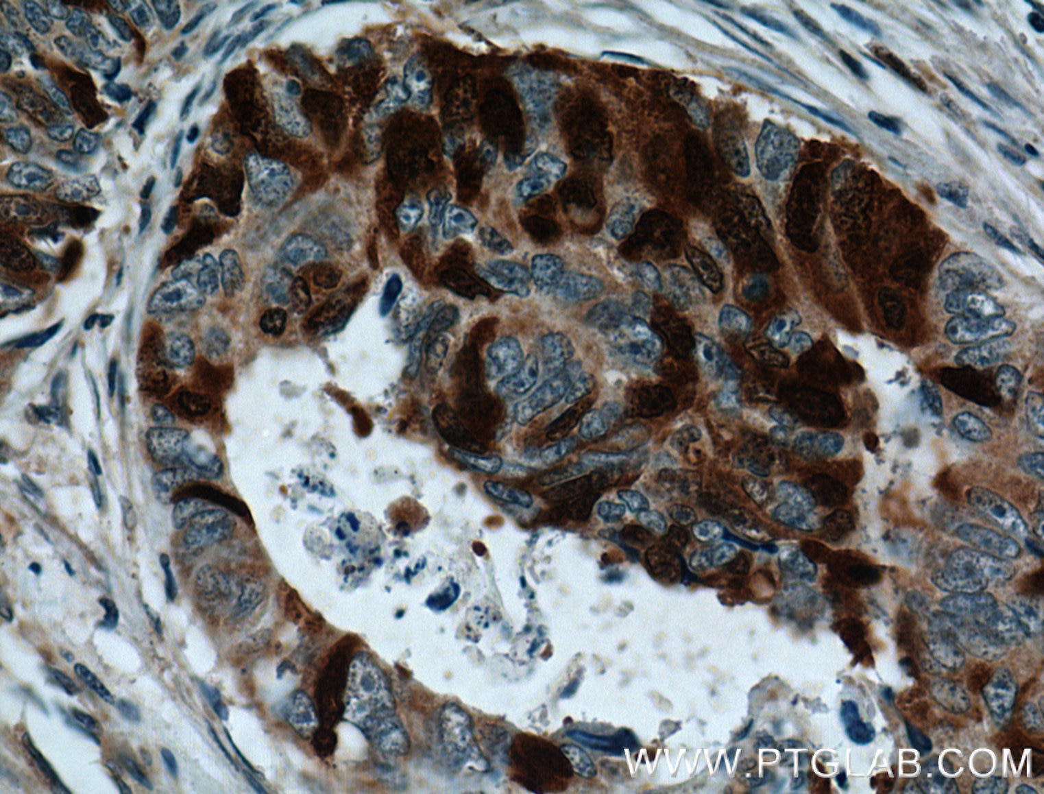 Immunohistochemistry (IHC) staining of human colon cancer tissue using UBE2C Polyclonal antibody (12134-2-AP)