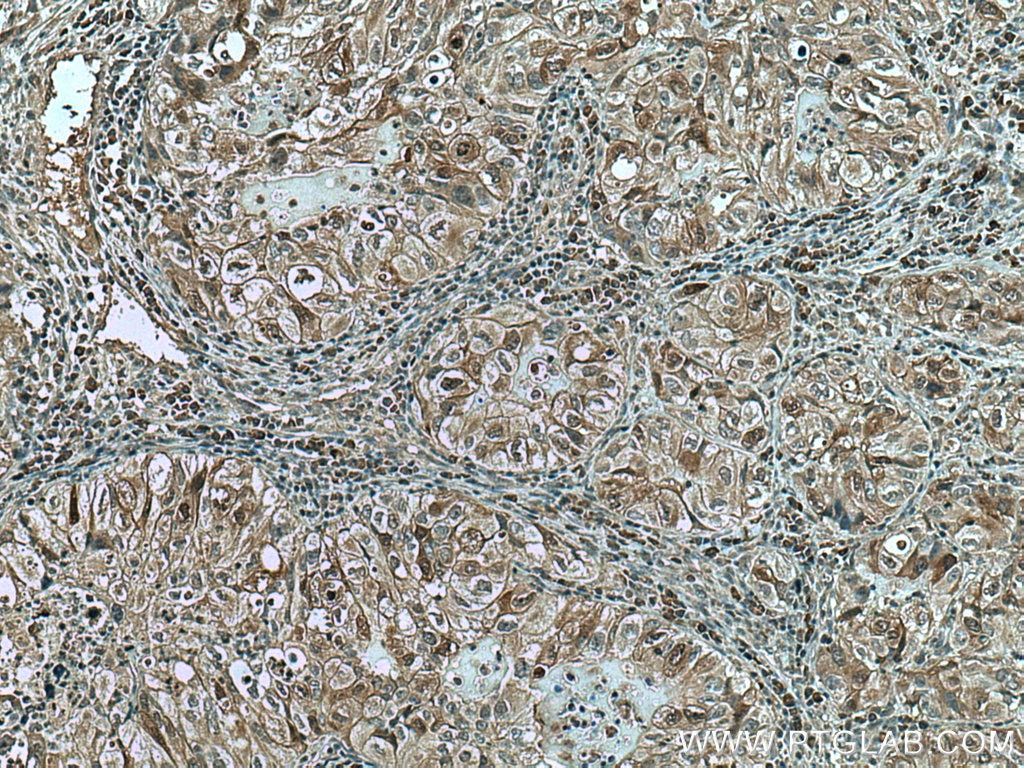 Immunohistochemistry (IHC) staining of human lung cancer tissue using UBE2C Monoclonal antibody (66087-1-Ig)