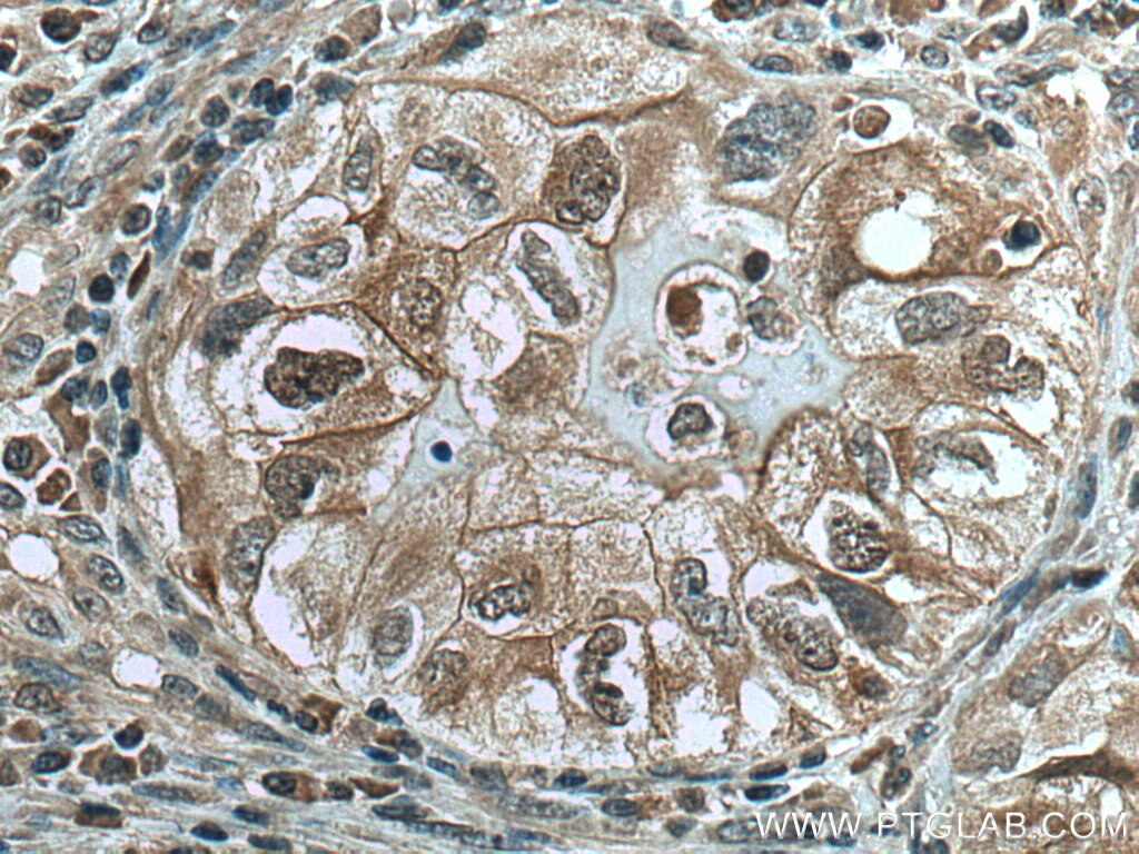 Immunohistochemistry (IHC) staining of human lung cancer tissue using UBE2C Monoclonal antibody (66087-1-Ig)