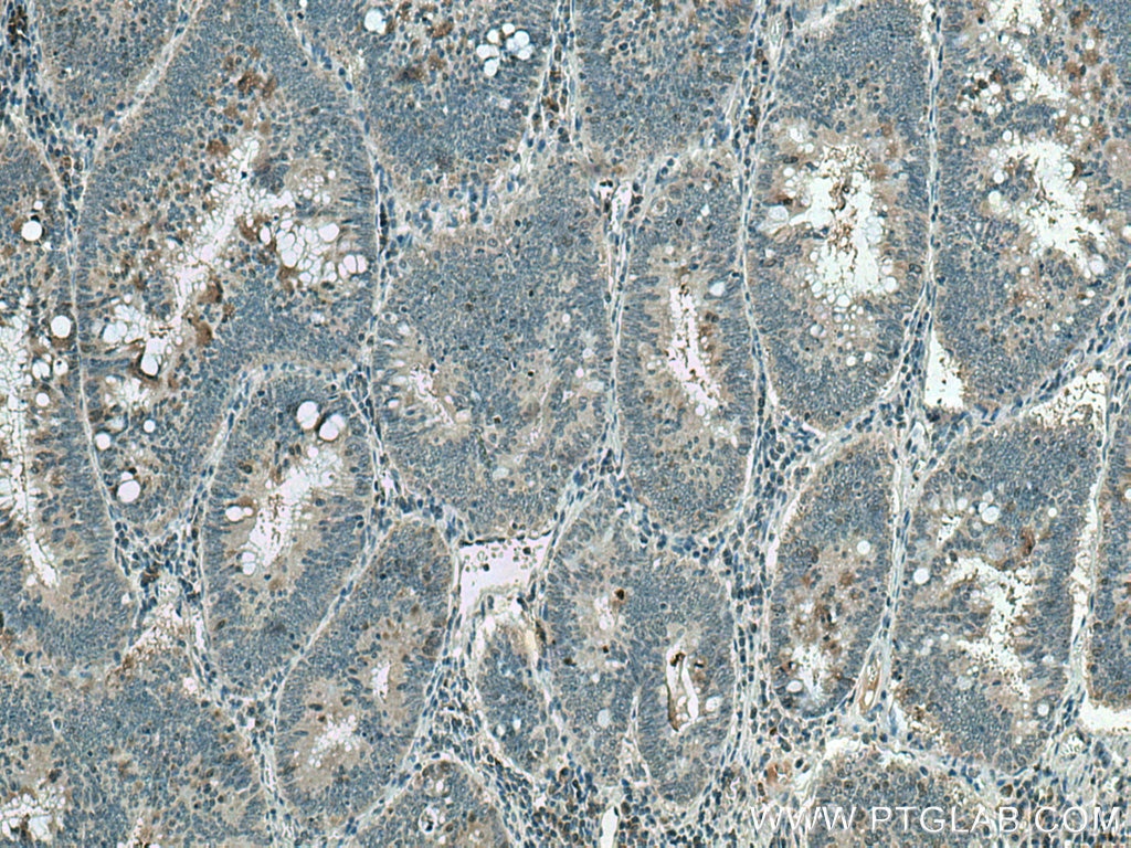 Immunohistochemistry (IHC) staining of human colon cancer tissue using UBE2C Monoclonal antibody (66087-1-Ig)