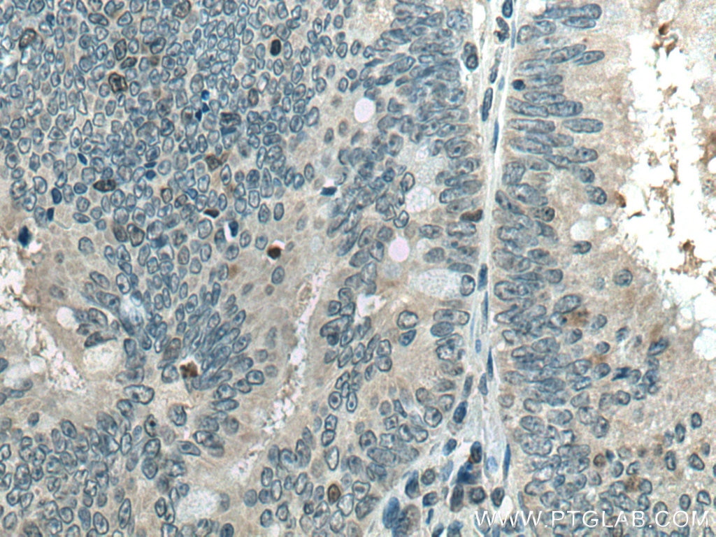 IHC staining of human colon cancer using 66087-1-Ig