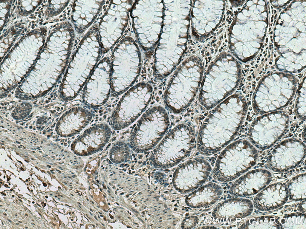 Immunohistochemistry (IHC) staining of human colon cancer tissue using UBE2C Monoclonal antibody (66087-1-Ig)