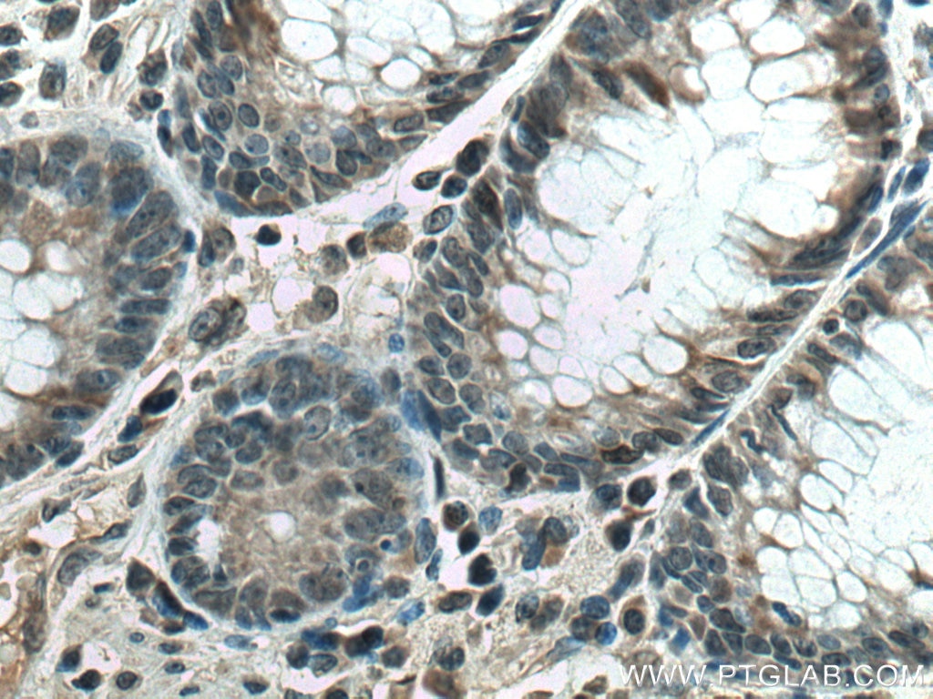 IHC staining of human colon cancer using 66087-1-Ig