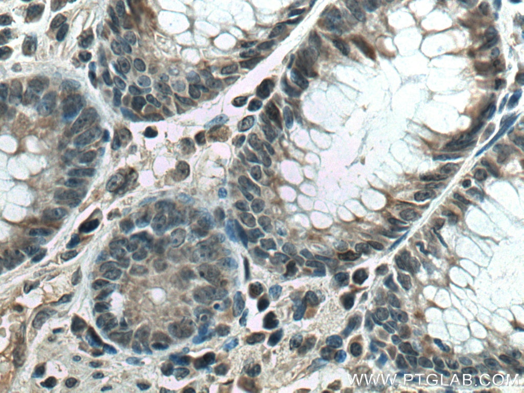 Immunohistochemistry (IHC) staining of human colon cancer tissue using UBE2C Monoclonal antibody (66087-1-Ig)