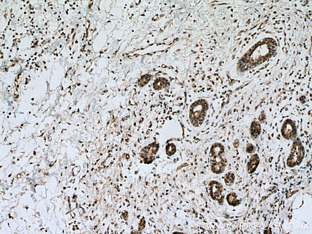 Immunohistochemistry (IHC) staining of human breast cancer tissue using UBE2D1/2/3/4 Polyclonal antibody (28328-1-AP)