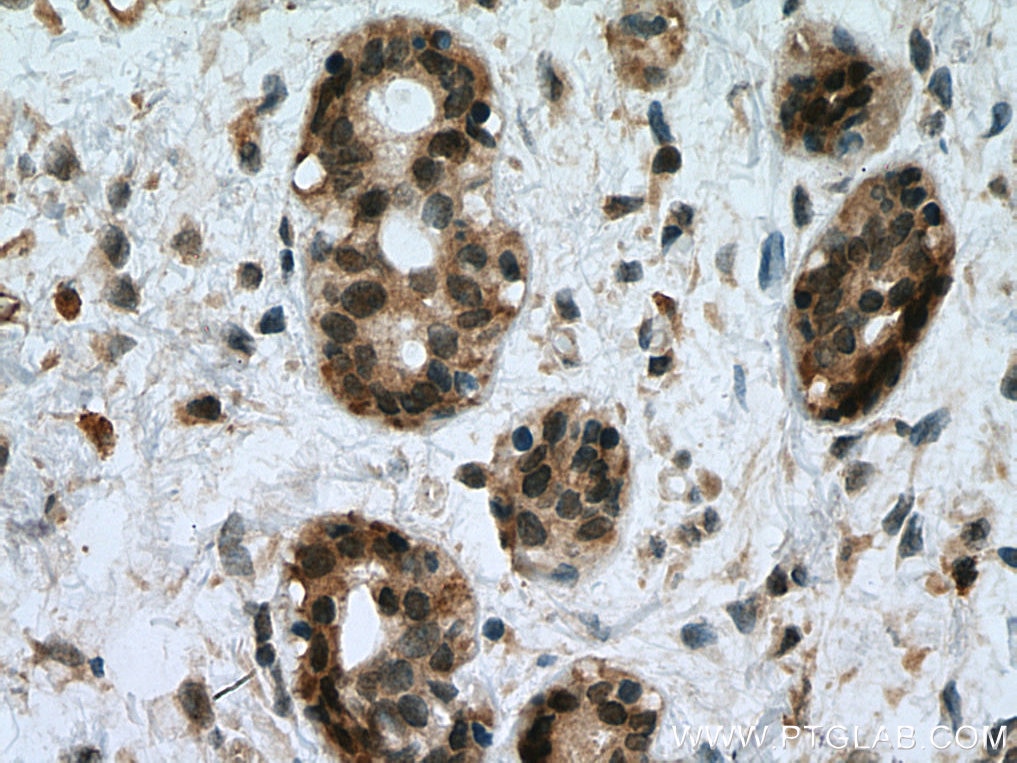 Immunohistochemistry (IHC) staining of human breast cancer tissue using UBE2D1/2/3/4 Polyclonal antibody (28328-1-AP)