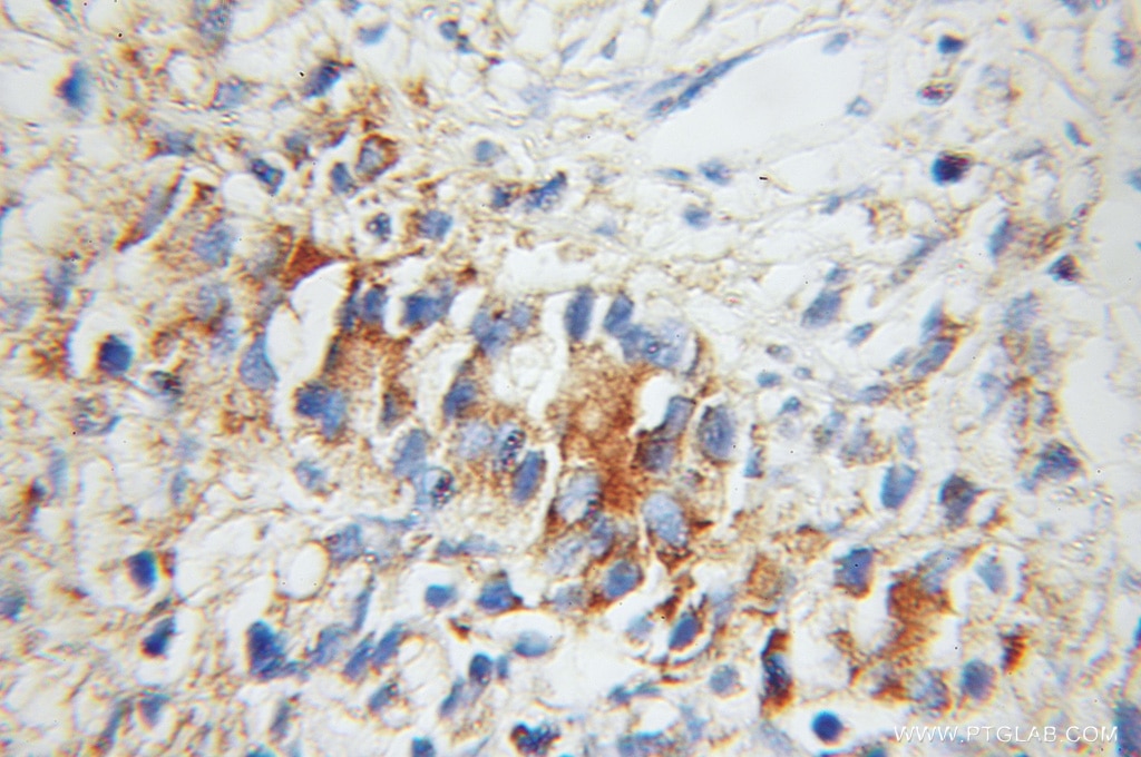 Immunohistochemistry (IHC) staining of human prostate cancer tissue using UBE2D1/2/3/4 Polyclonal antibody (11373-1-AP)