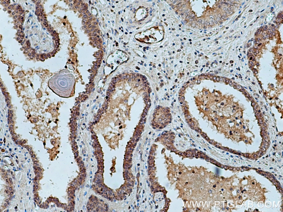 Immunohistochemistry (IHC) staining of human prostate cancer tissue using UBE2D1/2/3/4 Polyclonal antibody (11677-1-AP)