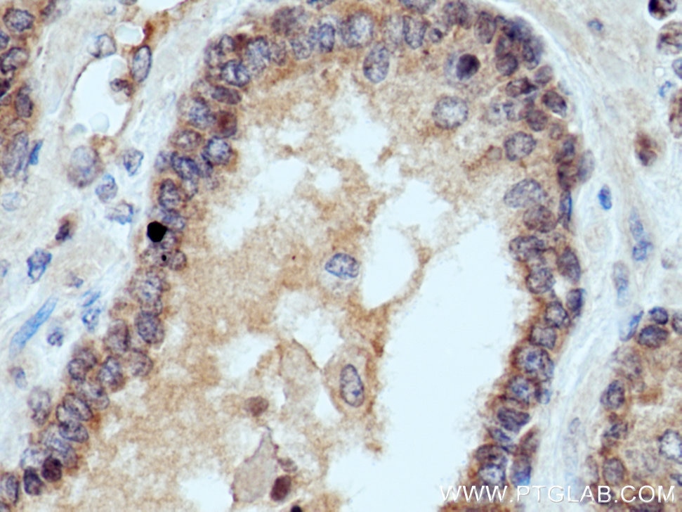 Immunohistochemistry (IHC) staining of human prostate cancer tissue using UBE2D1/2/3/4 Polyclonal antibody (11677-1-AP)