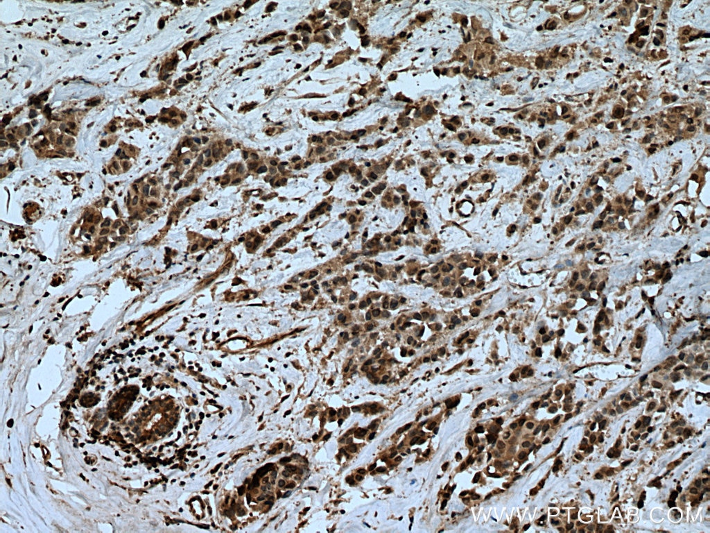 Immunohistochemistry (IHC) staining of human breast cancer tissue using UBE2D1/2/3/4 Polyclonal antibody (15475-1-AP)
