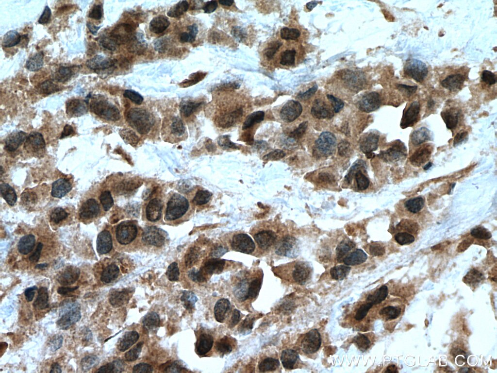 Immunohistochemistry (IHC) staining of human breast cancer tissue using UBE2D1/2/3/4 Polyclonal antibody (15475-1-AP)